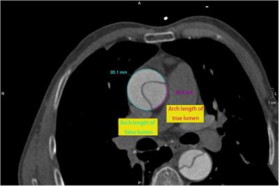 FL% is associated with the severity of acute DeBakey type I aortic dissection in patients undergoing frozen elephant trunk and total arch replacement